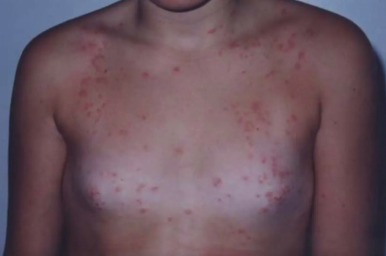 'Eu nunca tinha ouvido falar desse tipo de dermatite', diz pediatra