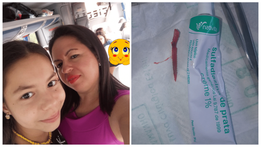 Sidineia e a filha passavam o Natal em Ilha Comprida, litoral de SP, quando Alexandra foi ferida pelo espinho venenoso de um peixe