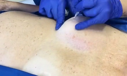 Objetivo é resgatar a autoestima das mulheres acometidas pelo câncer de mama, utilizando como técnica a dermopigmentação paramédica