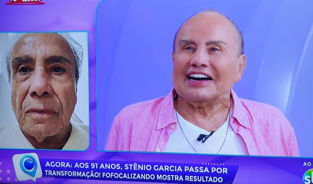 Stenio Garcia mostra resultado de harmonização facial no Fofocalizando