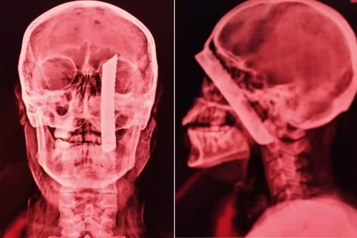 A vítima foi levada à Unidade de Pronto Atendimento de Agenor de Campos, porém devido à gravidade da lesão, foi transferida ao Hospital Irmã Dulce