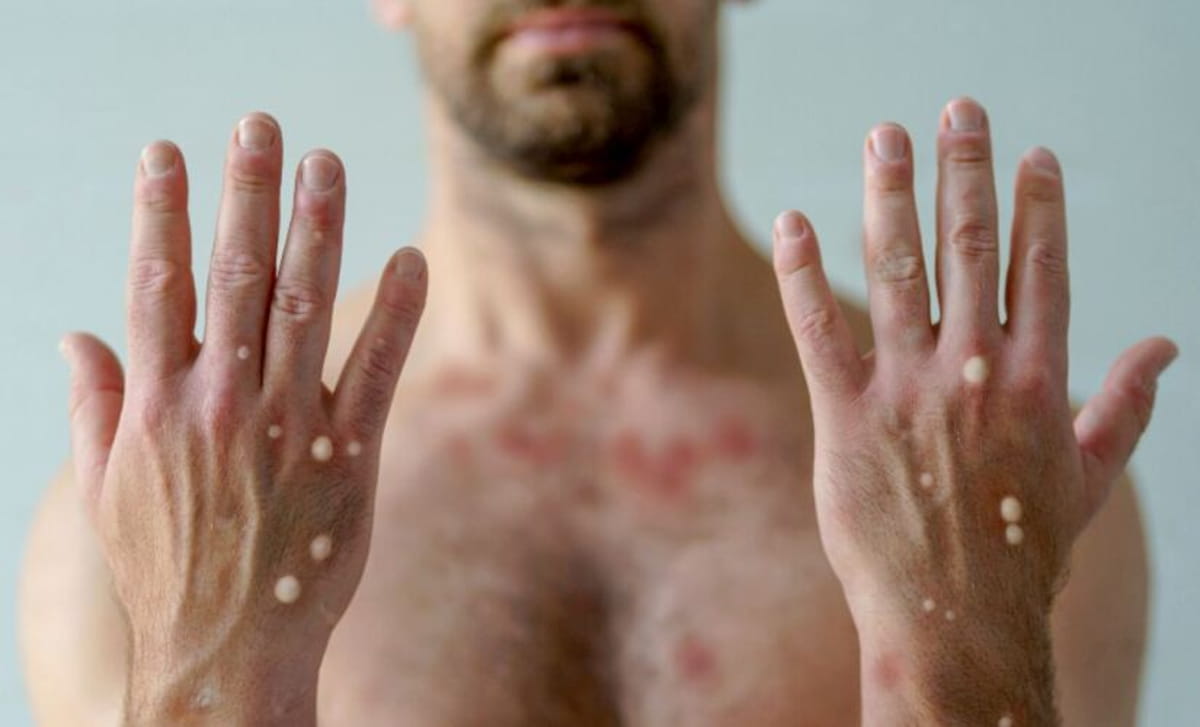 O estado confirmou o caso em três cidades da Baixada Santista e a Prefeitura de Santos confirmou mais um caso ontem (20)