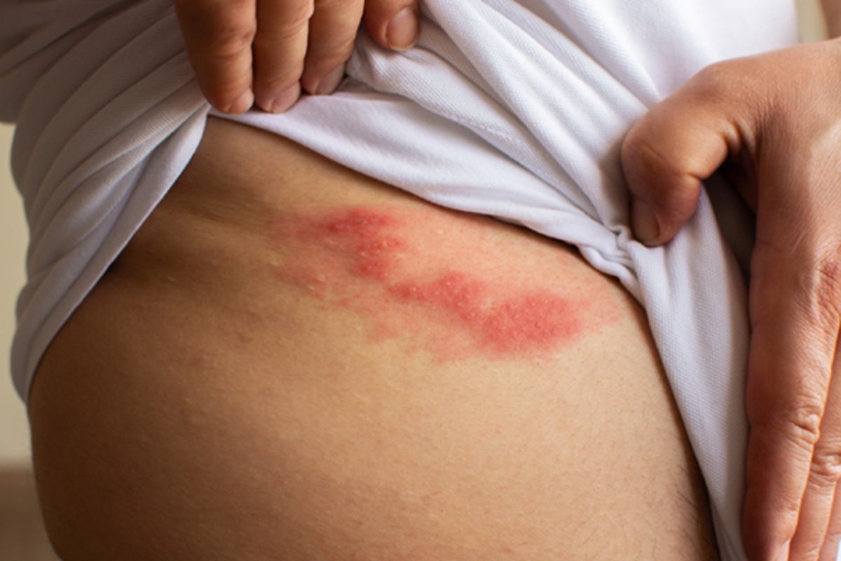 Origem do termo "cobreiro" está ligada a crenças populares que associavam lesões de pele ao toque de animais como aranhas, cobras ou sapos