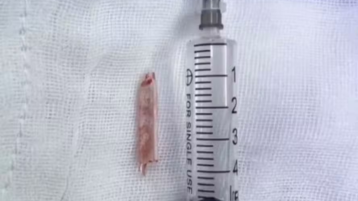 Somente no exame recente os especialistas conseguiram visualizar o pedaço de vidro preso atrás da pélvis