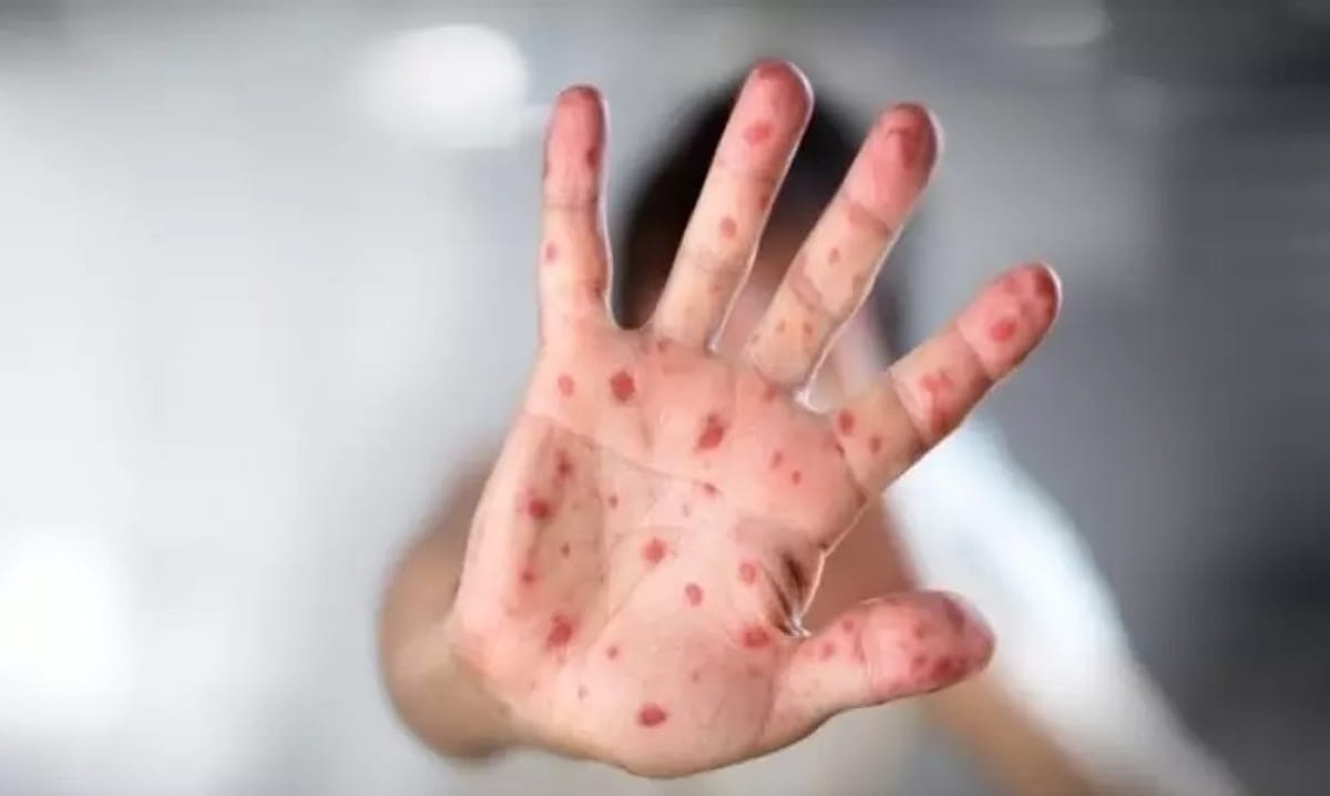 Mesmo após a recuperação, o vírus pode permanecer ativo nas fezes por até quatro semanas, facilitando novos surtos em locais como escolas e creches