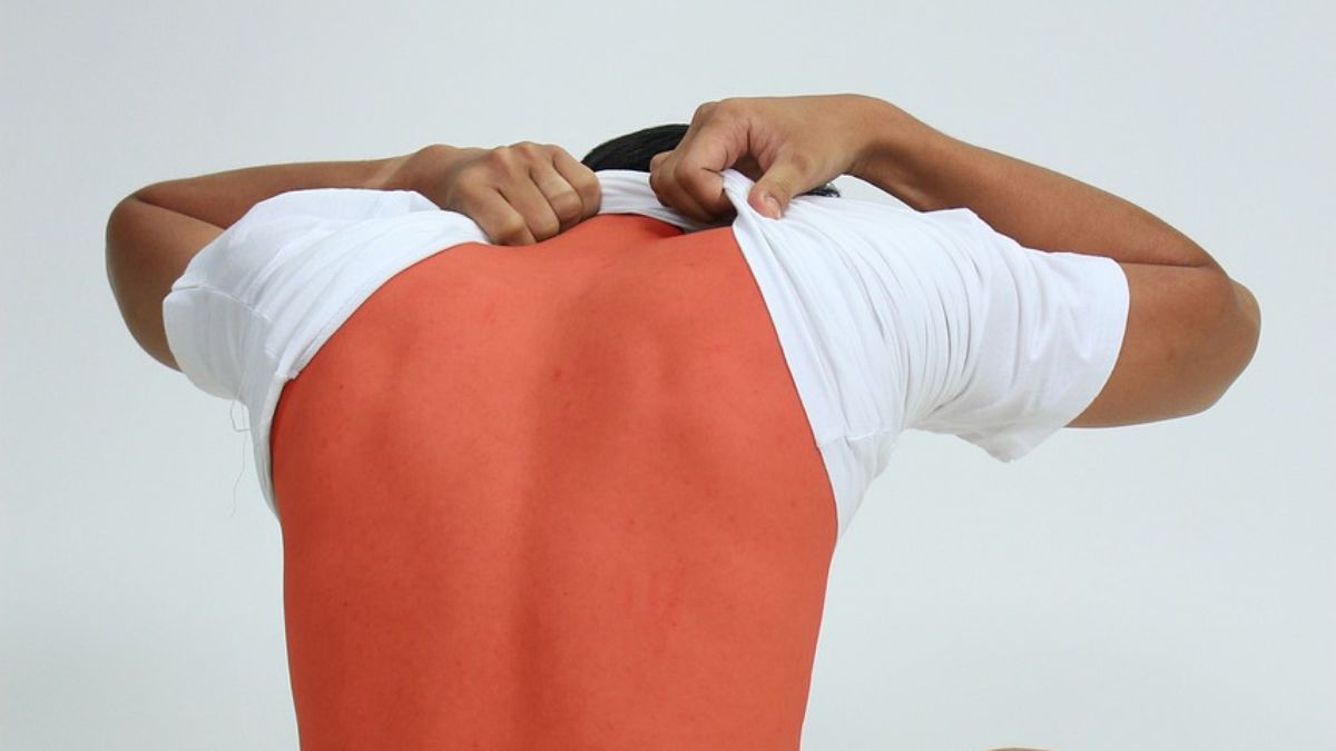 Jovens alegam que estão ficando "resistentes" ao sol