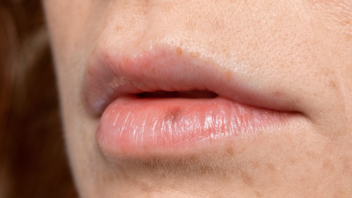 O vírus da herpes permanece dormente em um gânglio após causar uma primeira inflamação leve, mas pode 'acordar'