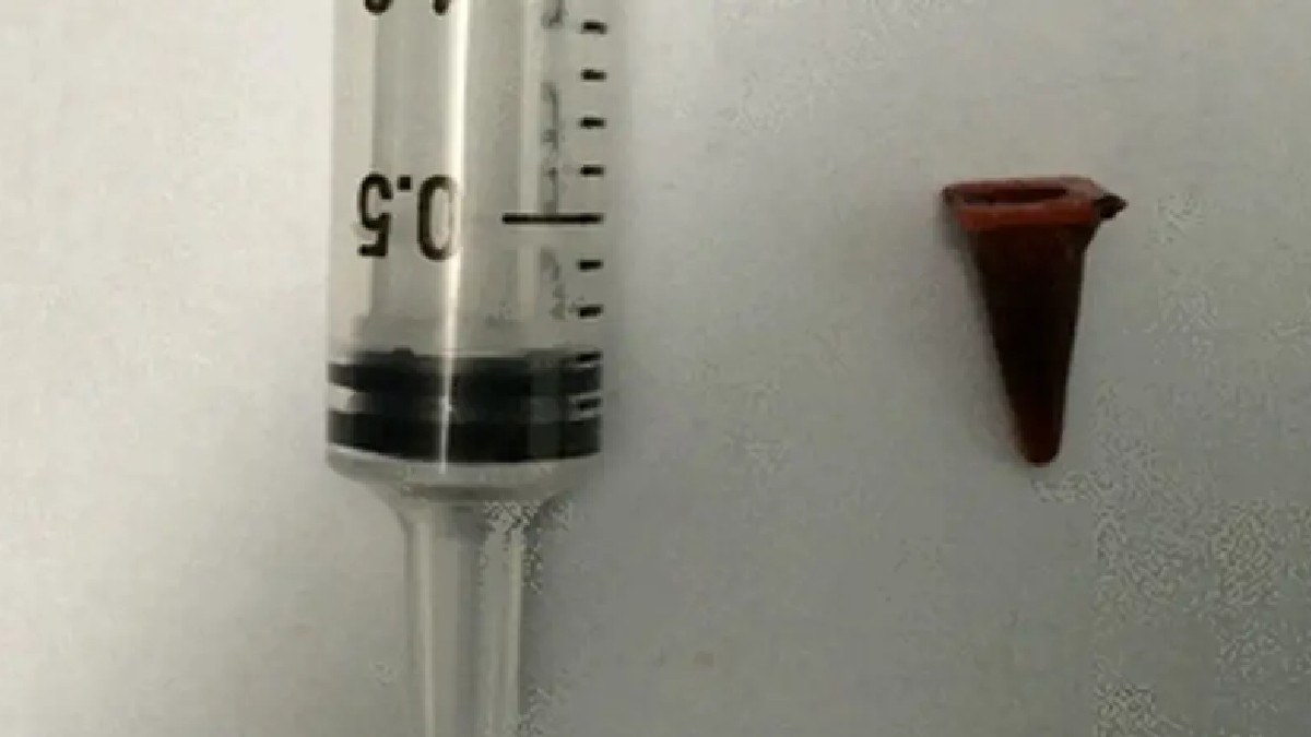 Paul Baxter havia inalado o brinquedo no sétimo aniversário e passou 40 anos com ele preso no pulmão