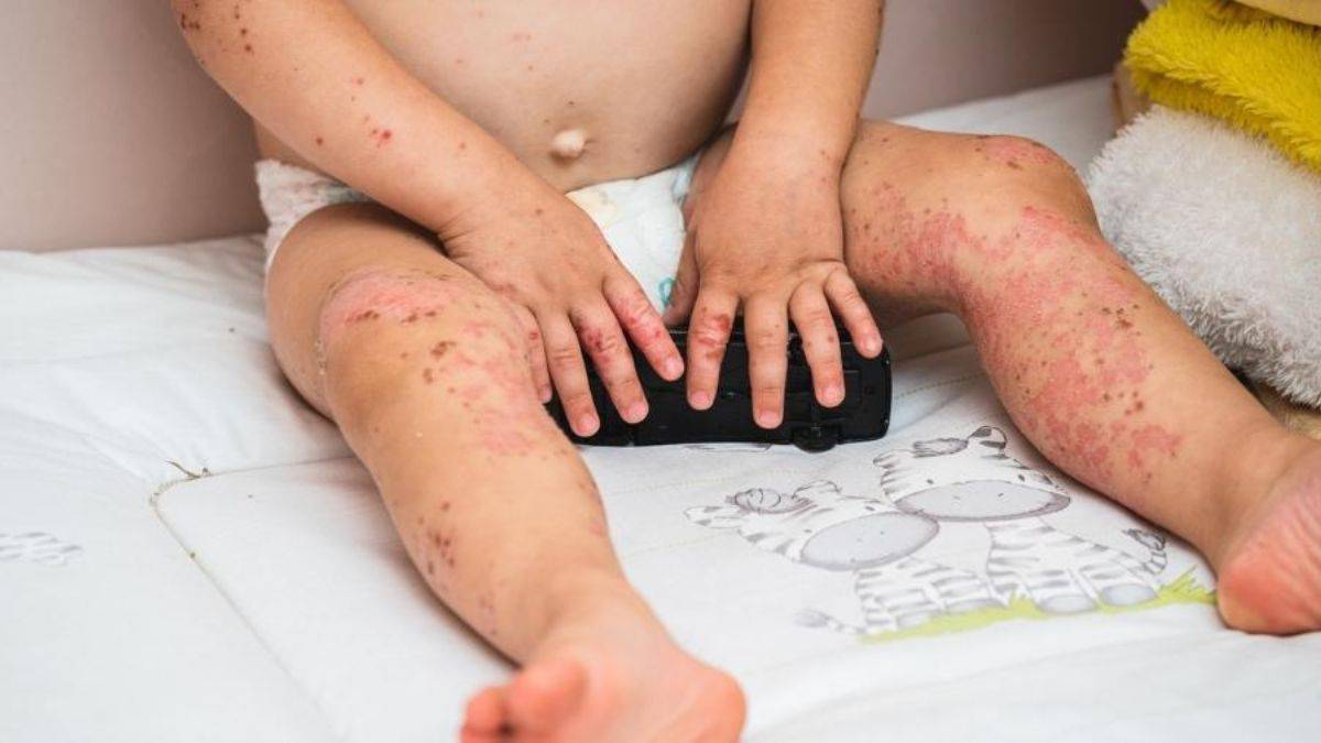 A doença afeta principalmente crianças com menos de cinco anos