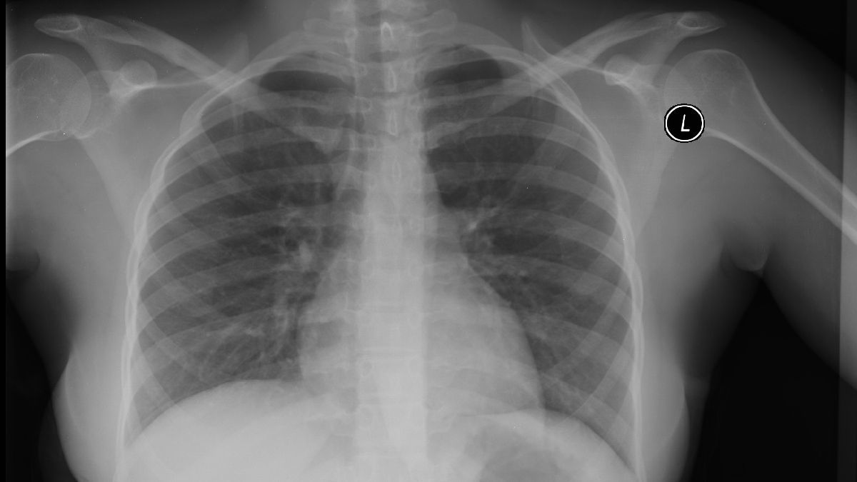A densidade mineral óssea foi medida por meio do exame DXA, um tipo avançado de raio X utilizado no diagnóstico de osteoporose.