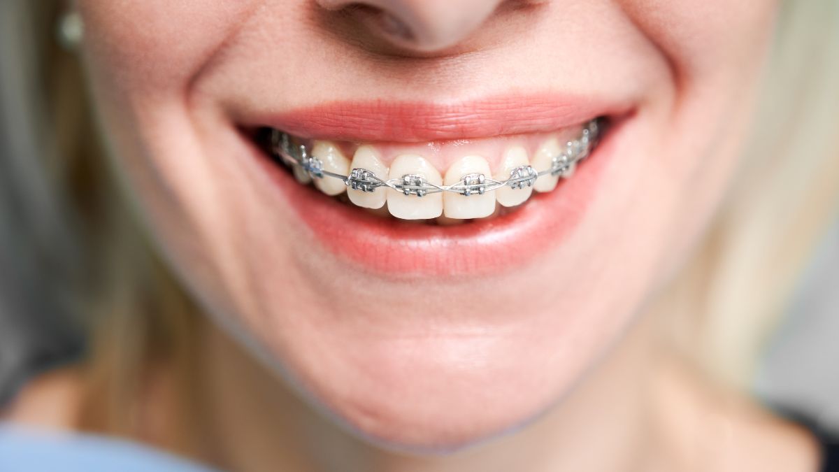 Dentes não ficam totalmente fixos ao longo da vida: mudanças naturais podem provocar movimentações dentárias, mesmo após o tratamento ortodôntico